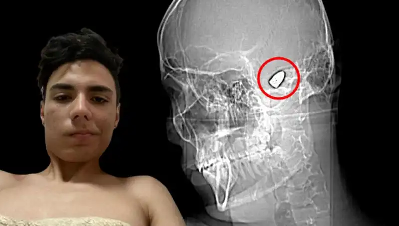 Kafasında Patlayıcı Bomba Taşıyan Adamın Hikayesi: Gerçek Bir Dram