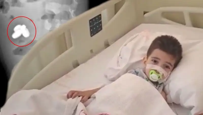 Pil ve Mıknatıs Yutan Çocuğun Bağırsakları Yanarak Hayati Tehlike Geçirdi